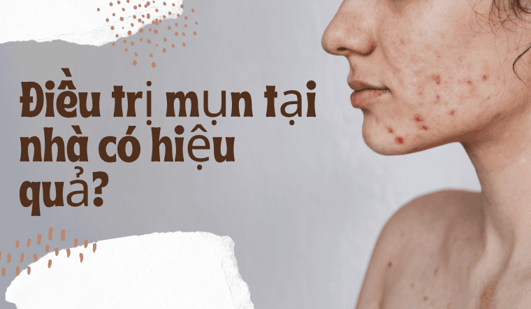 Điều trị mụn tại nhà