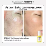 Tinh chất phục hồi ACNEMY