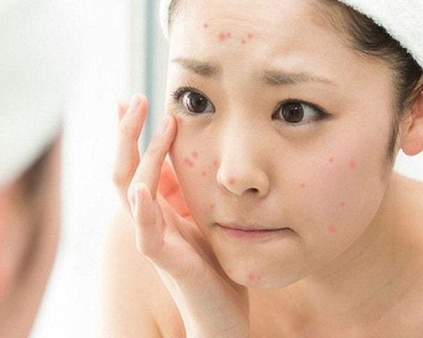Điều trị mụn tại nhà