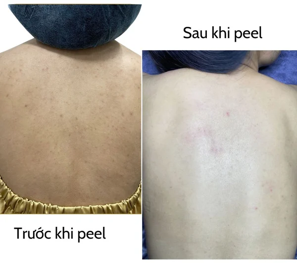 Peel Da Body Đúng Cách