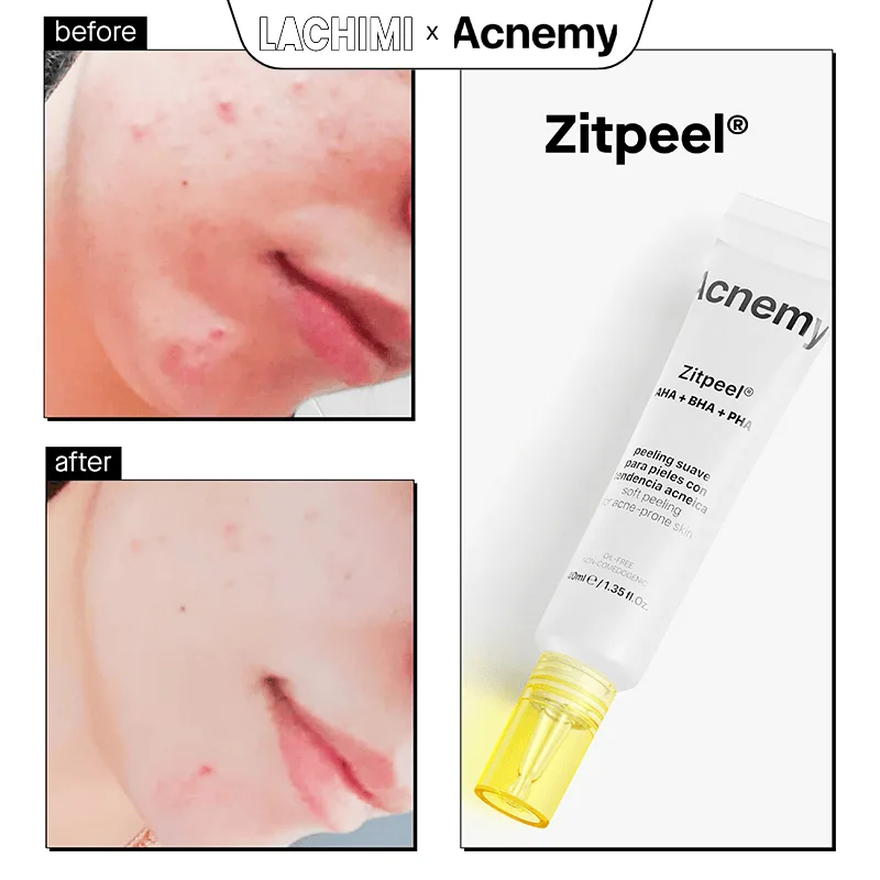 Peel da ACNEMY ZITPEEL