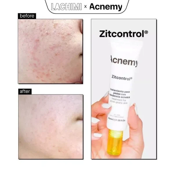kem trị mụn ACNEMY ZITCONTROL