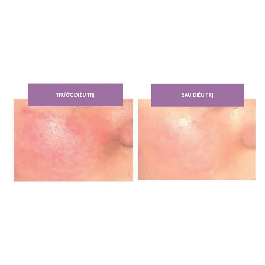 serum giảm đỏ da