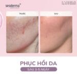 kem dưỡng làm dịu da Sesderma