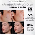 tẩy da chết AntiAc Exfo