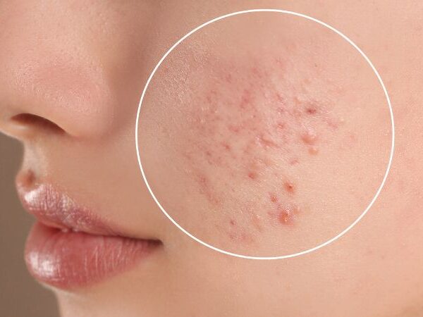 sữa rửa mặt cho da dầu mụn