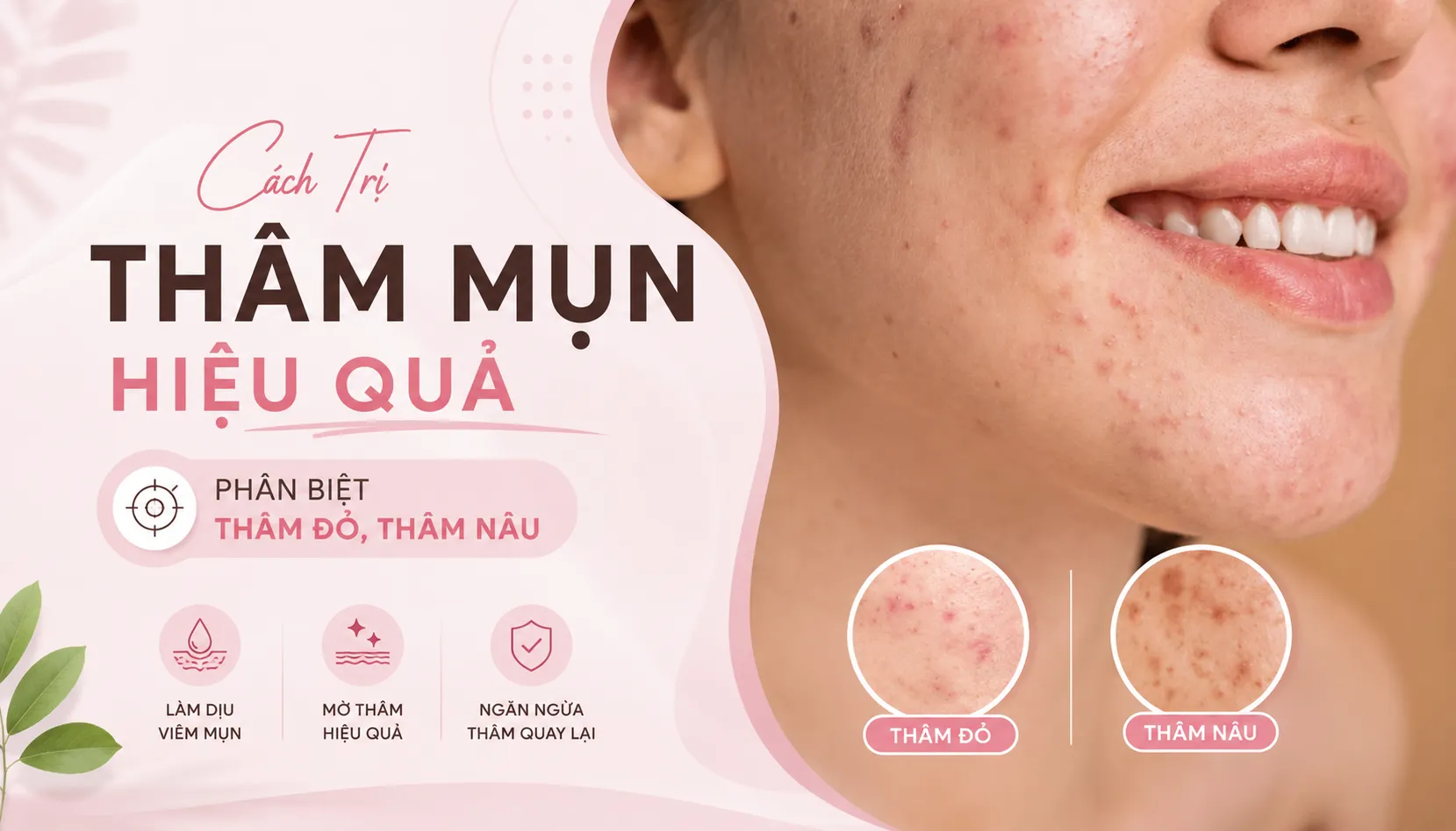 Cách Trị Thâm Mụn Hiệu Quả
