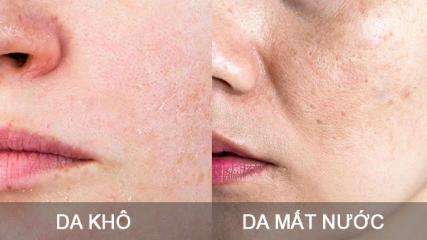 Da khô và da thiếu nước