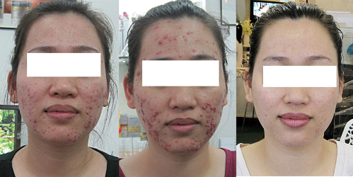 cac dau hieu nhiem corticoid